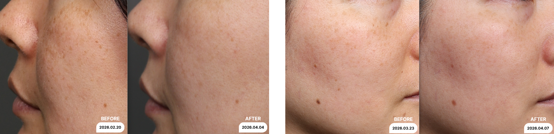 bbl before after
